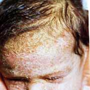 Seborrheic dermatitis